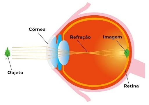 miopia astigmatismo e hipermetropia diferença