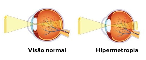 miopia e hipermetropia diferencia