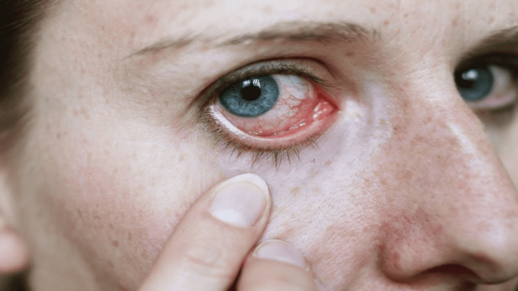 Vermelhidão no olho e irritação