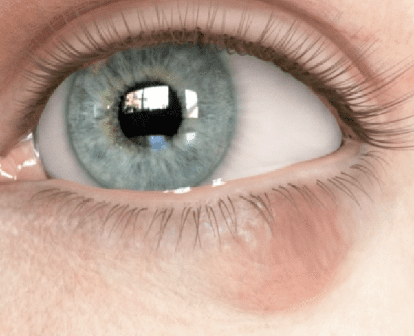 Calázio no olho o que é, causas, sintomas e tratamento