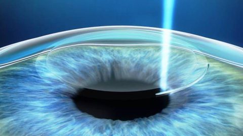 Conheça os tipos de cirurgias corretivas para os olhos