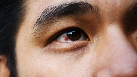 Glaucoma: o que é, sintomas e tratamento