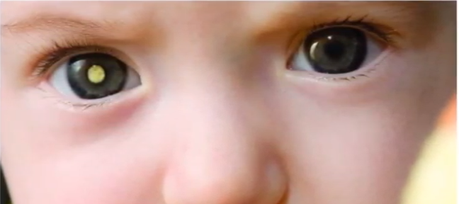 Criança com retinoblastoma