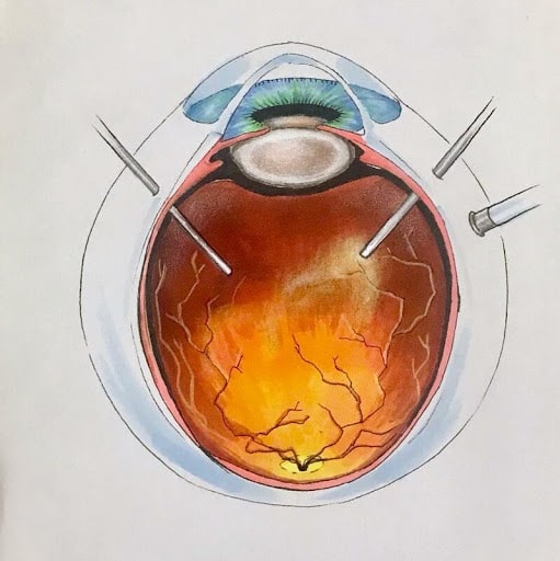Cirurgia de vitrectomia: três acessos no globo ocular 