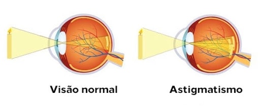 Doenças refrativas: visão normal x astigmatismo