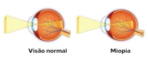 visão-normal-x-miopia