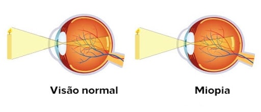 Alta miopia - visão-normal-x-miopia