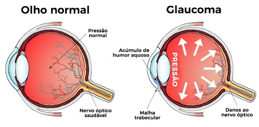 Pressão alta e glaucoma: existe alguma relação? - Viva Oftalmologia
