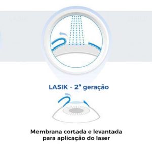 Qual o tempo de recuperação com o método LASIK?