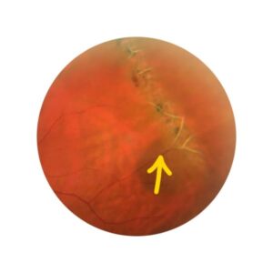 Degeneração periférica da retina