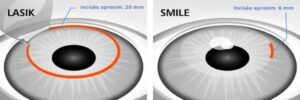 Como funciona a cirurgia de miopia SMILE 