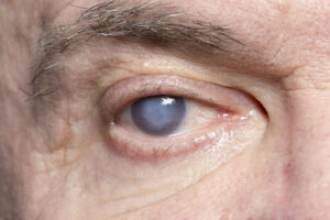 VIVA - Cirurgia ocular: mitos e verdades que você precisa saber