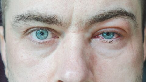 Olhos inchados: 8 principais causas e o que fazer para tratar!