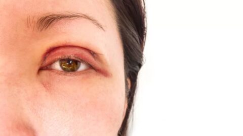 Herpes Ocular Com Gatilho Emocional: O que é, Sintomas e Tratamento