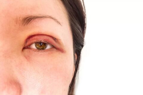Herpes Ocular Com Gatilho Emocional: O que é, Sintomas e Tratamento